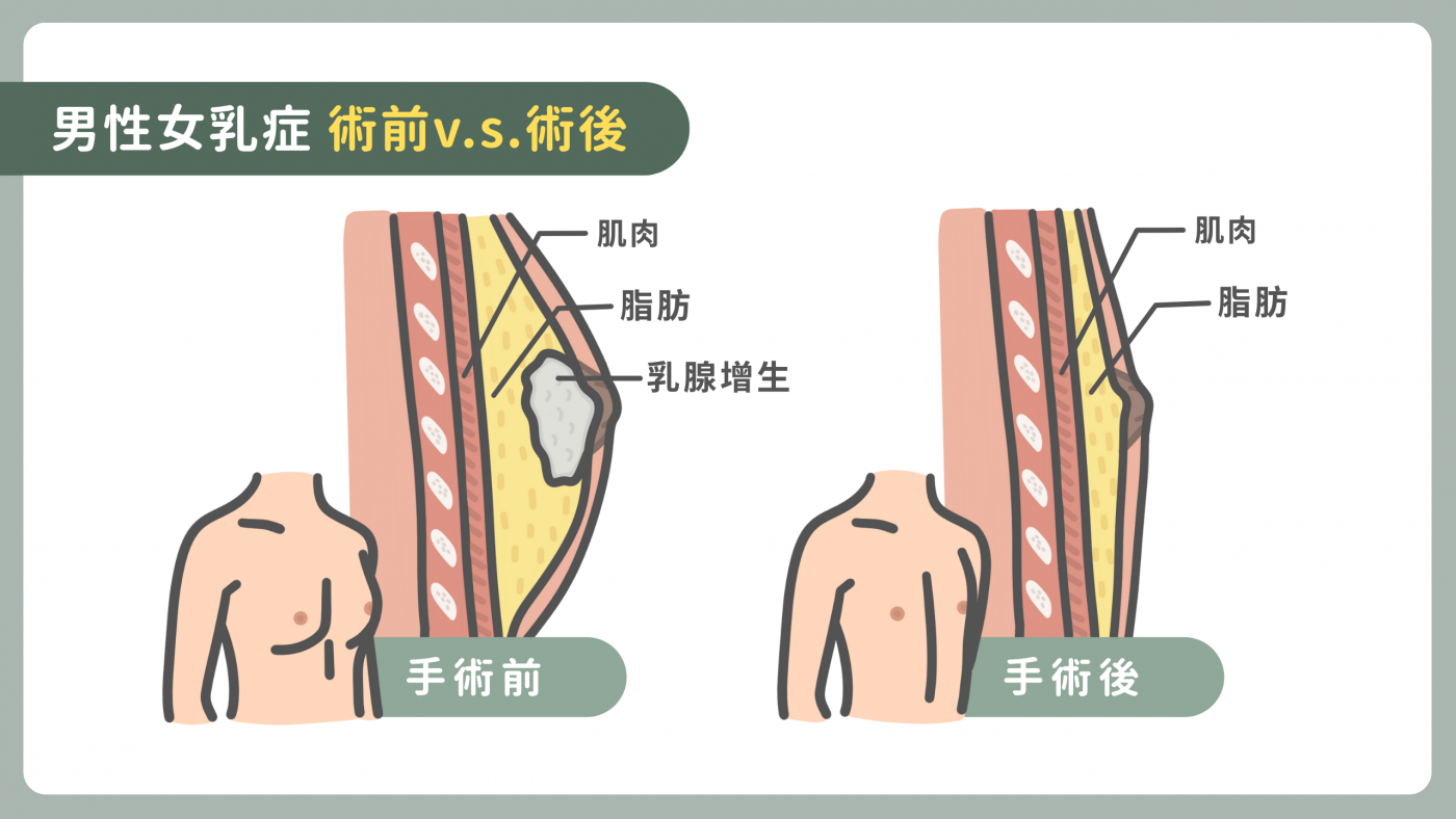 真性與假性女乳症判斷