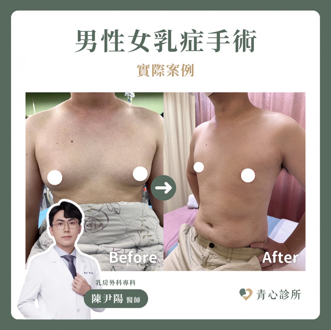 男性女乳症案例