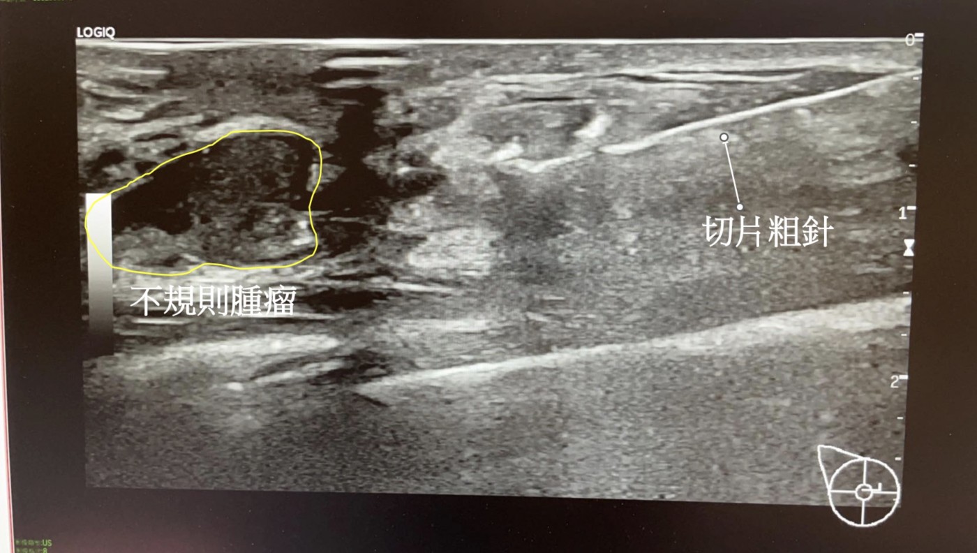乳房粗針切片示意